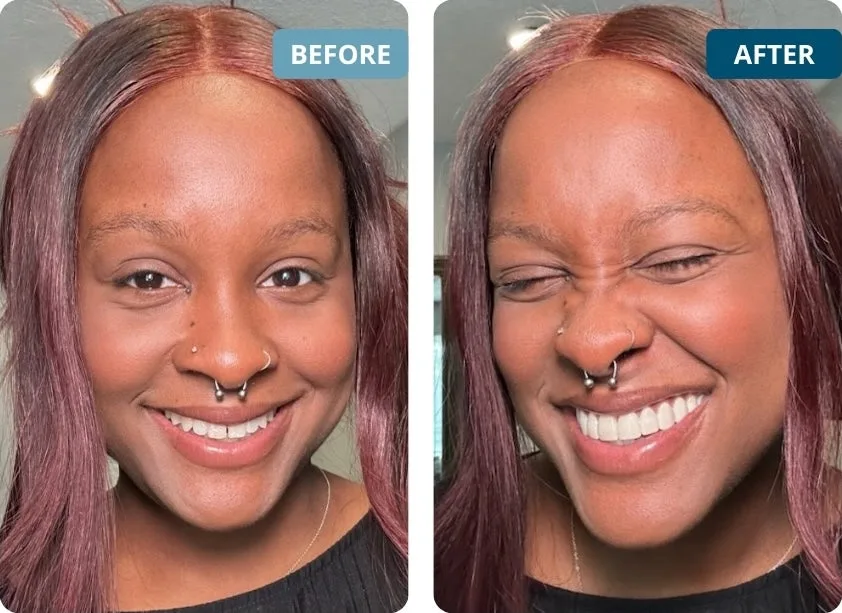 Peak Smile veneers concealing gaps and tooth discoloration in a before-and-after style photo