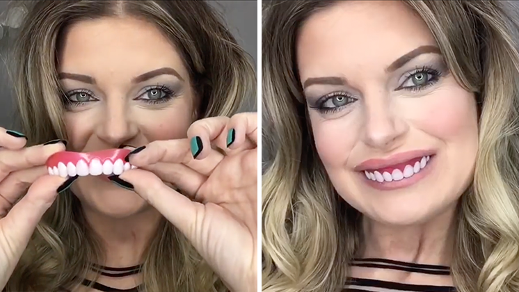 Shiny Smile Veneers — custom snap-on dental veneer craftsmanship