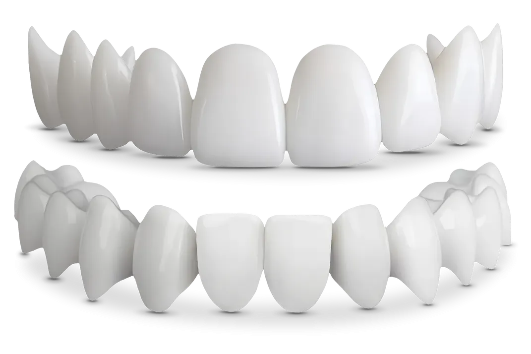 Shiny Smile Veneers — custom snap-on dental veneers